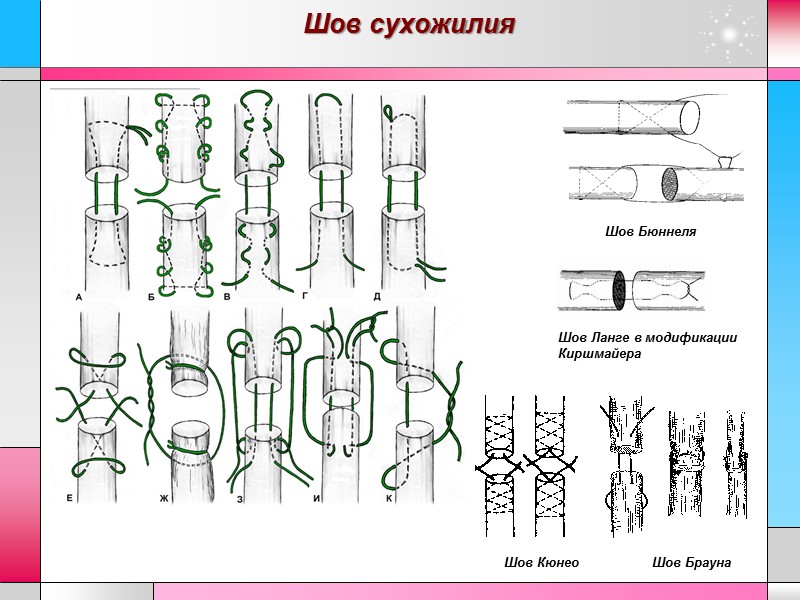 Шов сухожилия Шов Ланге в модификации Киршмайера Шов Бюннеля Шов Кюнео Шов Брауна